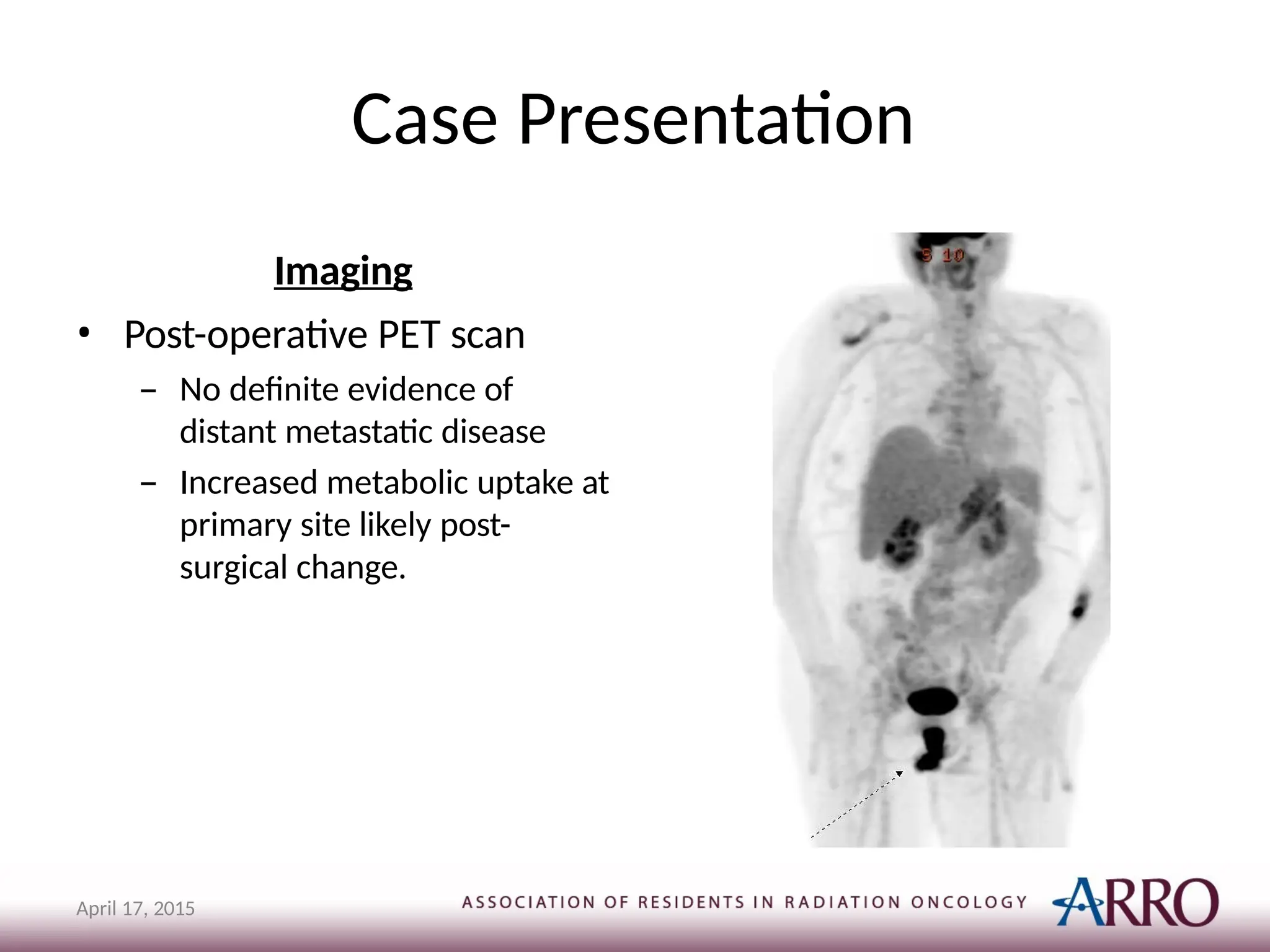 Case Presentation
Imaging
• Post-operative PET scan
– No definite evidence of
distant metastatic disease
– Increased metabolic uptake at
primary site likely post-
surgical change.
April 17, 2015
 