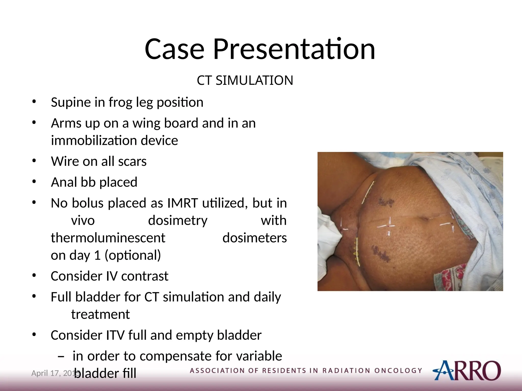 Case Presentation
CT SIMULATION
• Supine in frog leg position
• Arms up on a wing board and in an
immobilization device
• Wire on all scars
• Anal bb placed
• No bolus placed as IMRT utilized, but in
vivo dosimetry with
thermoluminescent dosimeters
on day 1 (optional)
• Consider IV contrast
• Full bladder for CT simulation and daily
treatment
• Consider ITV full and empty bladder
– in order to compensate for variable
bladder fill
April 17, 2015
 