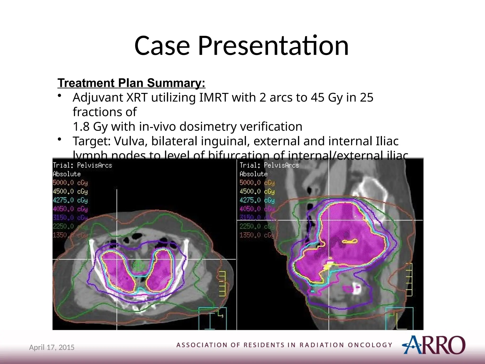 Case Presentation
Treatment Plan Summary:
• Adjuvant XRT utilizing IMRT with 2 arcs to 45 Gy in 25
fractions of
1.8 Gy with in-vivo dosimetry verification
• Target: Vulva, bilateral inguinal, external and internal Iliac
lymph nodes to level of bifurcation of internal/external iliac
April 17, 2015
 