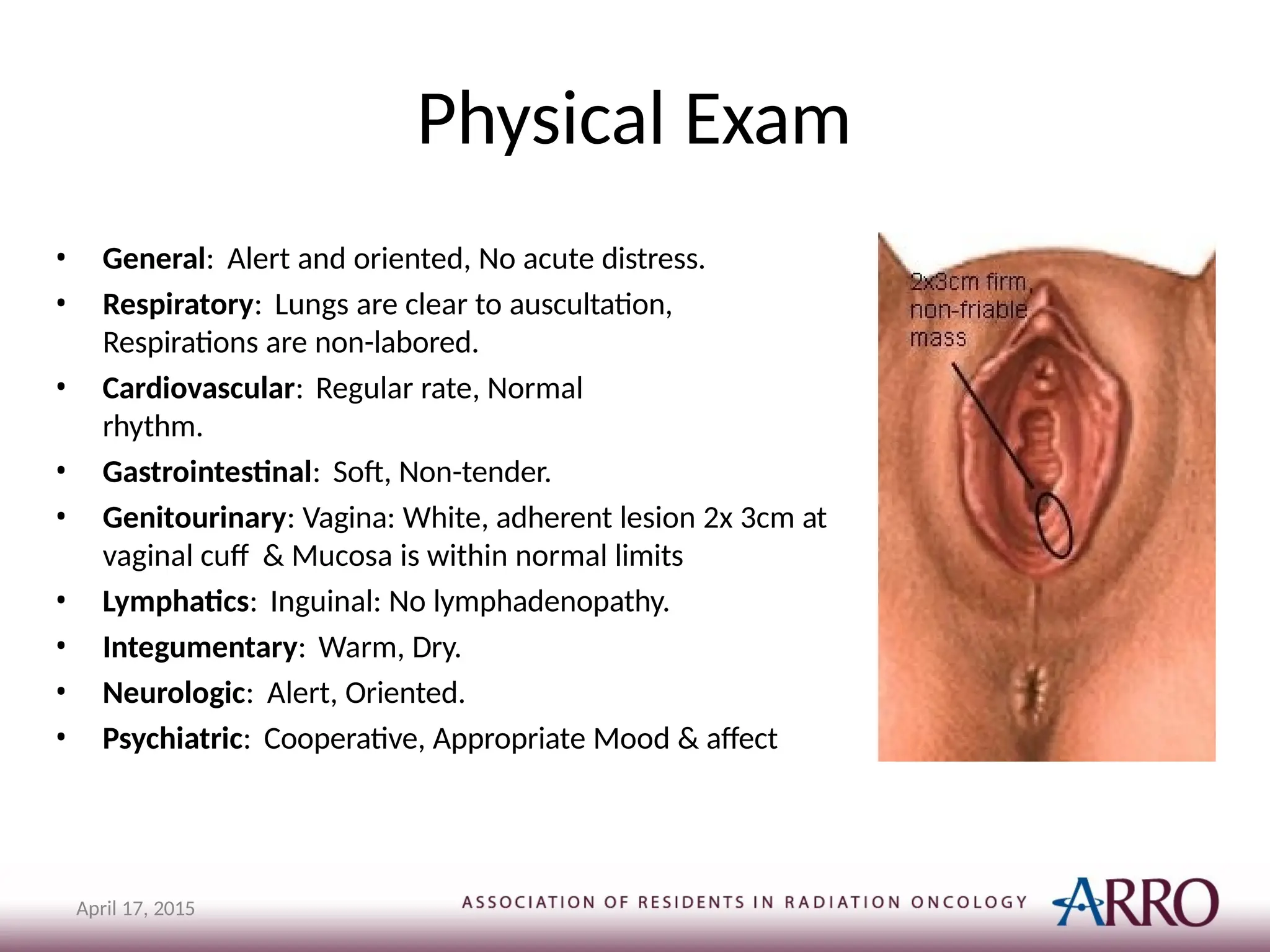 Physical Exam
• General: Alert and oriented, No acute distress.
• Respiratory: Lungs are clear to auscultation,
Respirations are non-labored.
• Cardiovascular: Regular rate, Normal
rhythm.
• Gastrointestinal: Soft, Non-tender.
• Genitourinary: Vagina: White, adherent lesion 2x 3cm at
vaginal cuff & Mucosa is within normal limits
• Lymphatics: Inguinal: No lymphadenopathy.
• Integumentary: Warm, Dry.
• Neurologic: Alert, Oriented.
• Psychiatric: Cooperative, Appropriate Mood & affect
April 17, 2015
 
