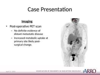 Case Presentation
Imaging
• Post-operative PET scan
– No definite evidence of
distant metastatic disease
– Increased metabolic uptake at
primary site likely post-
surgical change.
April 17, 2015
 