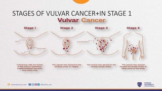 STAGES OF VULVAR CANCER+IN STAGE 1
 