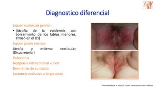 Diagnostico diferencial
Liquen escleroso genital :
• (Atrofia de la epidermis con
borramiento de los labios menores,
atrasó en el Dx)
Liquen plano erosivo:
Atrofia y eritema vestibular,
(Dispareunia )
Vulvodinia
Neoplasia intraepitelial vulvar
Dermatitis de contacto
Lactancia exclusiva a largo plazo
Enfermedades de la vulva,19.2 Vulva y menopausia Laura Vallejos
 