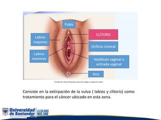 Consiste en la extirpación de la vulva ( labios y clítoris) como
tratamiento para el cáncer ubicado en esta zona.
Tomado de: https://elsyreyes.com/como-llegar-al-orgasmo-mujer/
 