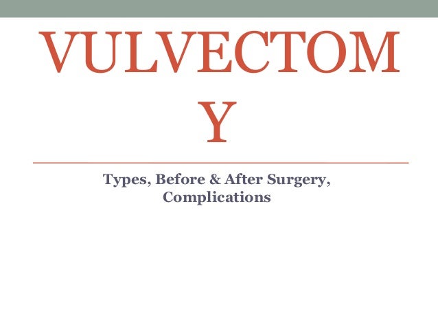 VULVECTOM
Y
Types, Before & After Surgery,
Complications
 