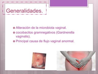 Generalidades.
 Alteración de la microbiota vaginal.
 cocobacilos gramnegativos (Gardnerella
vaginalis).
 Principal causa de flujo vaginal anormal.
 