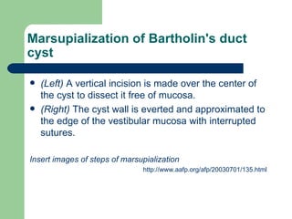 Marsupialization of Bartholin's duct cyst (Left)  A vertical incision is made over the center of the cyst to dissect it free of mucosa. (Right)  The cyst wall is everted and approximated to the edge of the vestibular mucosa with interrupted sutures.  Insert images of steps of marsupialization http://www.aafp.org/afp/20030701/135.html 