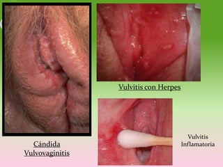 Vulvitis con Herpes




                                         Vulvitis
  Cándida                              Inflamato...