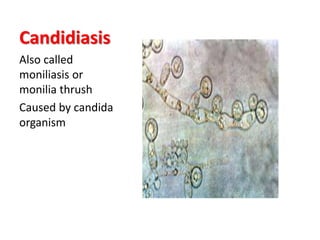 Candidiasis
Also called
moniliasis or
monilia thrush
Caused by candida
organism
 