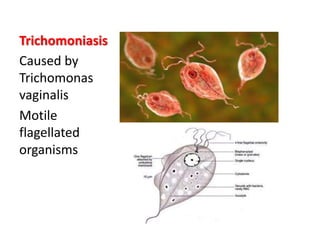 Trichomoniasis
Caused by
Trichomonas
vaginalis
Motile
flagellated
organisms
 