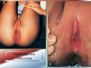 Vulvovaginitis
Infecciosa
 