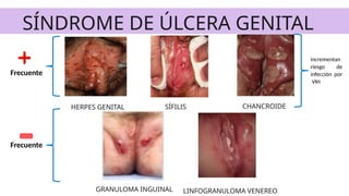 SÍNDROME DE ÚLCERA GENITAL
Frecuente
HERPES GENITAL CHANCROIDE
SÍFILIS
Frecuente
GRANULOMA INGUINAL LINFOGRANULOMA VENEREO
incrementan
riesgo de
infección por
VIH
 