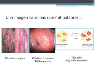 Una imagen vale más que mil palabras…
Candidiasis vaginal Cérvix en frambuesa
Trichomoniasis
“Clue cells”
Vaginosis bacteriana
 