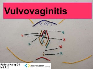 Vulvovaginitis
Fátima Kang Gil
M.I.R 2
 