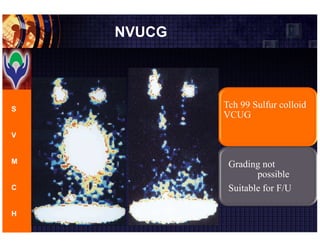 Vesicoureteric Reflux- commonest cause for pediatric UTI | PDF