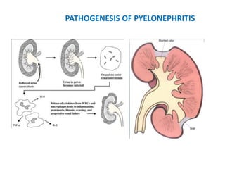 PATHOGENESIS OF PYELONEPHRITIS
 