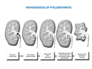 PATHOGENESIS OF PYELONEPHRITIS
 