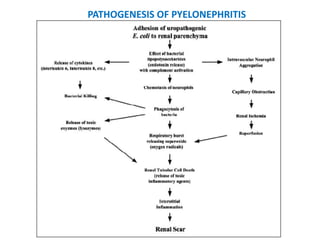 PATHOGENESIS OF PYELONEPHRITIS
 