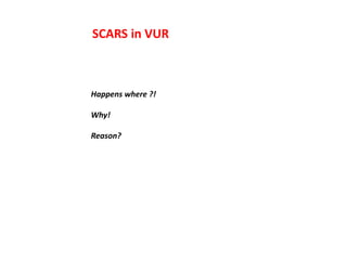 SCARS in VUR
Happens where ?!
Why!
Reason?
 