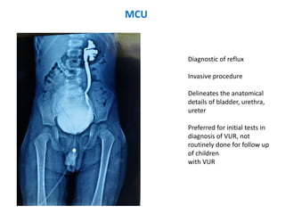 MCU
Diagnostic of reflux
Invasive procedure
Delineates the anatomical
details of bladder, urethra,
ureter
Preferred for initial tests in
diagnosis of VUR, not
routinely done for follow up
of children
with VUR
 
