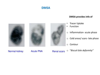 DMSA
• Tracer Uptake
• Function
o Inflammation- acute phase
o Cold areas/ scars- late phase
o Contour
o “Biscuit bite deformity”
DMSA provides info of
 