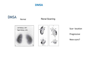 Scar- location
Progressive
New scars?
DMSA
 