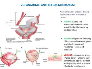 VUJ ANATOMY- ANTI REFLUX MECHANISM
 FILLING- Allows the
intramural ureter to move
in within the hiatus during
bladder filling
 FILLING-Progressive obliquity
of intravesical ureter–trigone
stretched-- increased
resistance– increased
pressure
 VOIDING- Intravesival ureter-
-Pulled down– ureteral wall
compressed against bladder
wall– passive reinforcement
of valvular mechanism
Natural tone of ureteral muscle-
active closure of intravesical
ureter
 
