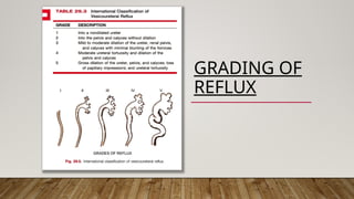 Vesicoureteral reflux disease in children | PPTX
