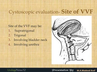 Cystoscopic evaluation- Site   of VVF

Site of the VVF may be:
1. Supratrigonal
2. Trigonal
3. Involving bladder neck
4. Involving urethra
 