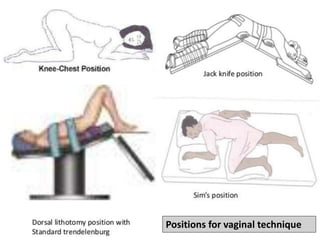 Positions for vaginal technique