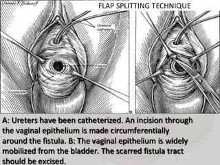Vesico-Vaginal Fistula (VVF)