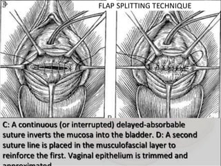 Vesico-Vaginal Fistula (VVF)
