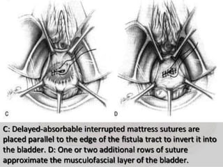 Vesico-Vaginal Fistula (VVF)