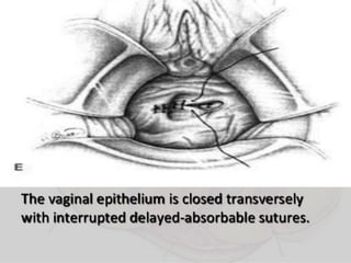 Vesico-Vaginal Fistula (VVF)