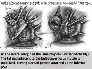 Vesico-Vaginal Fistula (VVF)