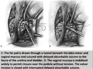 Vesico-Vaginal Fistula (VVF)