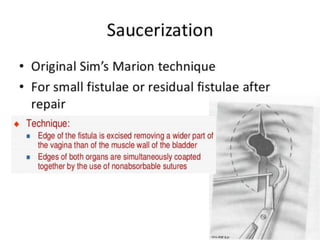 Vesico-Vaginal Fistula (VVF)