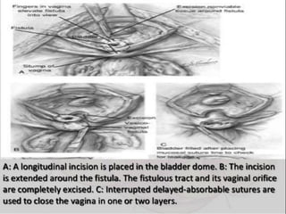 Vesico-Vaginal Fistula (VVF)