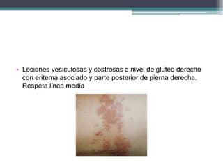 • Lesiones vesiculosas y costrosas a nivel de glúteo derecho
con eritema asociado y parte posterior de pierna derecha.
Res...