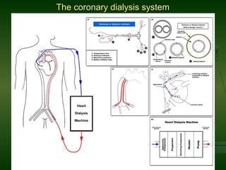 The coronary dialysis systemThe coronary dialysis system
 