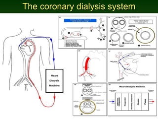 The coronary dialysis systemThe coronary dialysis system
 