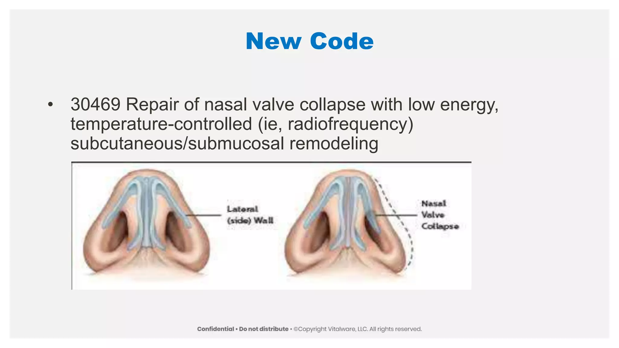 New Code
• 30469 Repair of nasal valve collapse with low energy,
temperature-controlled (ie, radiofrequency)
subcutaneous/submucosal remodeling
 