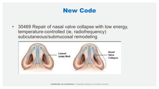 New Code
• 30469 Repair of nasal valve collapse with low energy,
temperature-controlled (ie, radiofrequency)
subcutaneous/submucosal remodeling
 