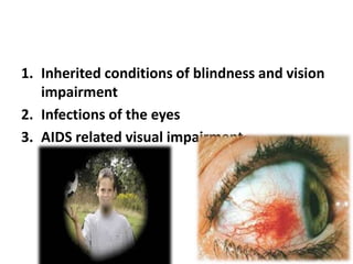 1. Inherited conditions of blindness and vision
impairment
2. Infections of the eyes
3. AIDS related visual impairment
 