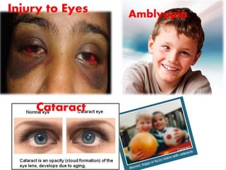 Injury to Eyes Amblyopia
Cataract
 