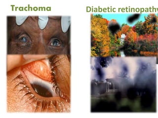 Trachoma Diabetic retinopathy
 