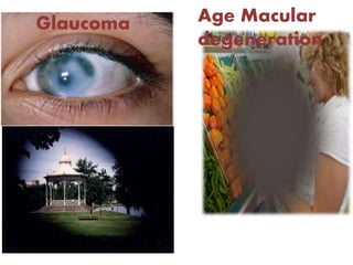 Glaucoma Age Macular
degeneration
 
