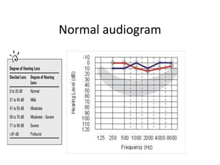 Normal audiogram
 