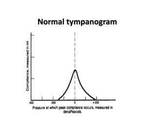Normal tympanogram
 