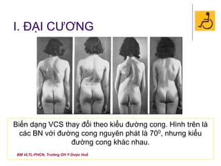 BM VLTL-PHCN, Trường DH Y Dược Huế
I. ĐẠI CƯƠNG
Biến dạng VCS thay đổi theo kiểu đường cong. Hình trên là
các BN với đường cong nguyên phát là 700, nhưng kiểu
đường cong khác nhau.
 